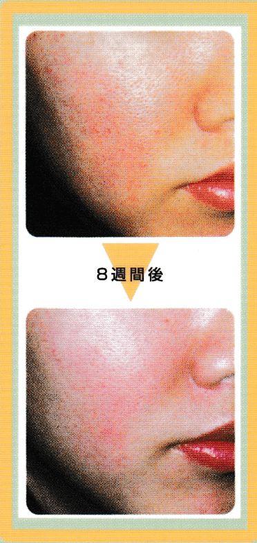 肌の赤みや凹凸が改善された様子を示す、8週間後の比較写真